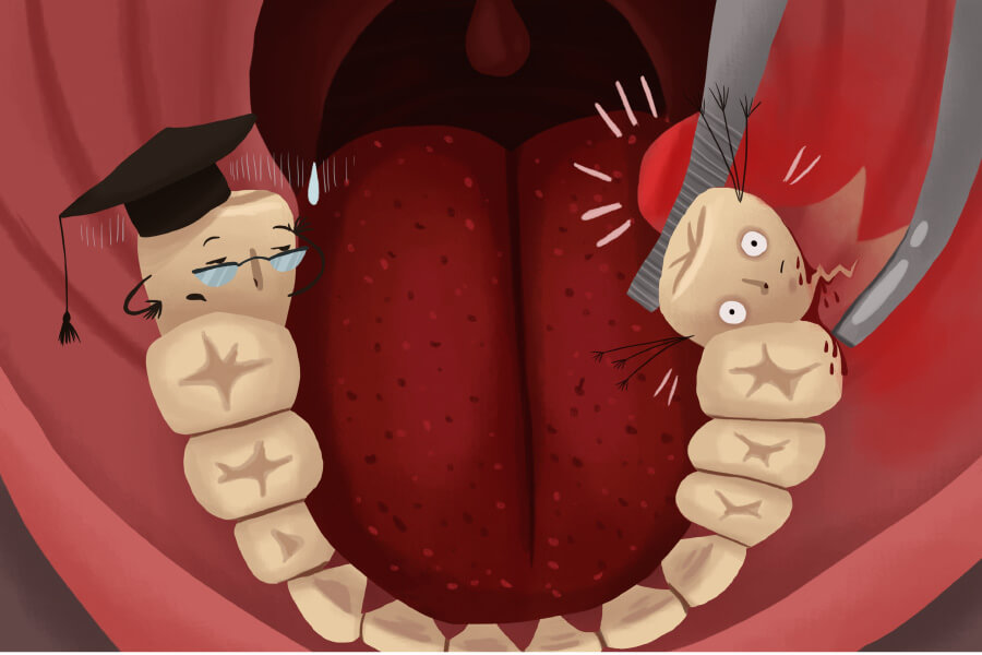Cartoon image of wisdom teeth that need to be removed due to overcrowding and increased risk of dental disease