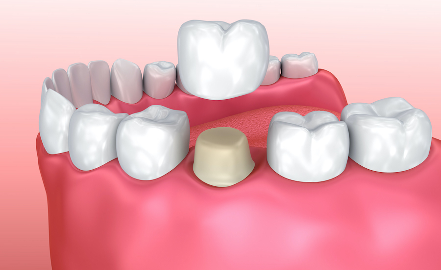 Closeup of a mouth model with a custom dental crown