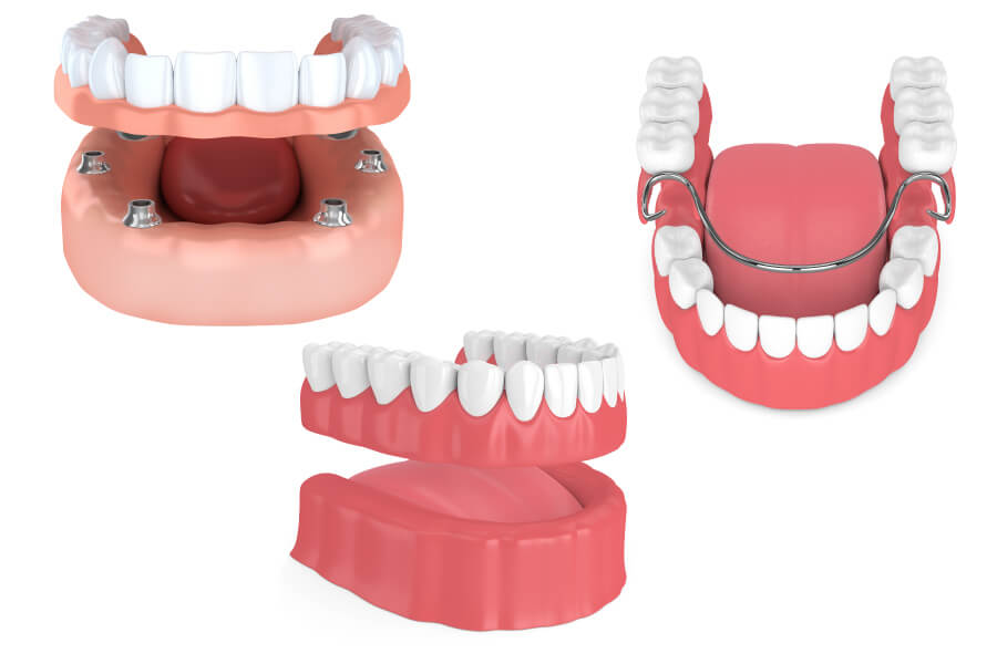 3 different types of dentures: implant-supported, removable full, and removable partial dentures