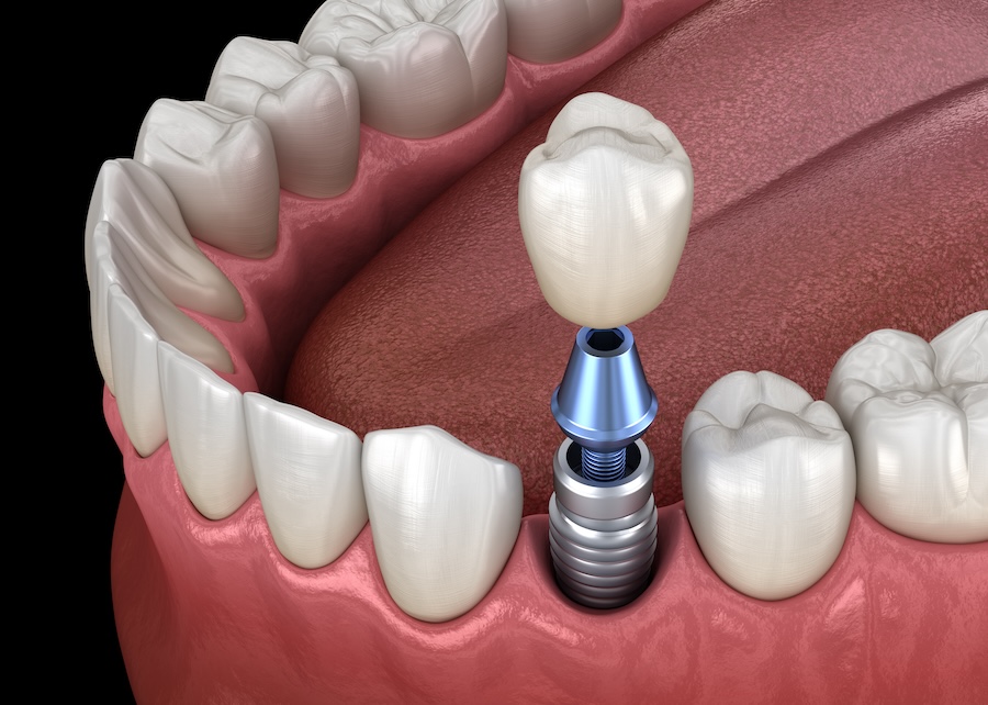 dental implants care, oral hygiene for implants, Indian Trail NC dentist, dental check-ups, Pleasant Plains Dental