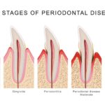 the stages of gum disease on an infographic from healthy gums to advanced periodontal disease