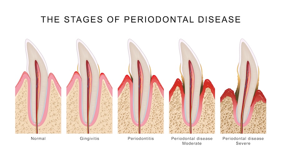 the stages of gum disease on an infographic from healthy gums to advanced periodontal disease