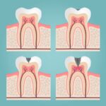 early decay, small cavity, incipient decay