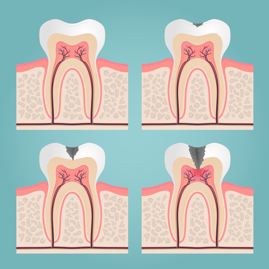 early decay, small cavity, incipient decay